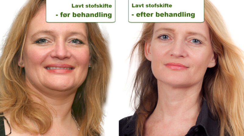 Helle Sydendal før og efter behandling af lavt stofskifte