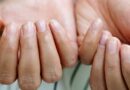 Nærbillede af fingernegle med langsgående riller